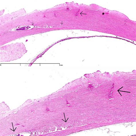 Histopathology of the enucleated eye of case 18. Transscleral scarring ...