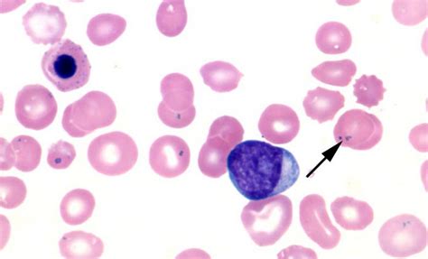 Pappenheimer bodies VS Howell-Jolly bodies Differentiation | Medical ...