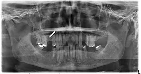 Maxillary Sinus Mucosal Thickening