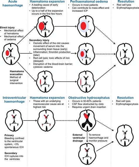 Intracerebral Hemorrhage Locations