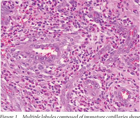 Figure 1 from Angiolymphoid Hyperplasia with Eosinophilia | Semantic Scholar