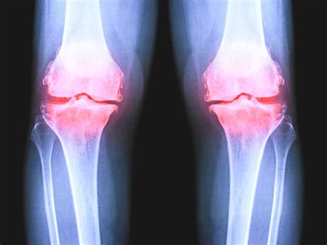 Osteoarthritis of the Knee X-Ray