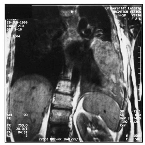 Histology reveals an undifferentiated spindle cell like sarcoma with... | Download Scientific ...