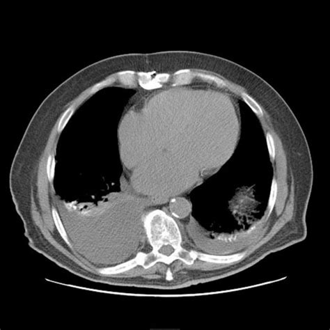 Aspiration pneumonia bacterial infection ct scan - wikidoc