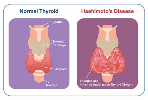 Hashimoto’s Thyroiditis | American Thyroid Association