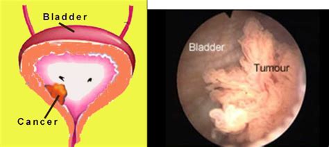 Bladder Cancer | Chin Chong Min Urology & Robotic Surgery Centre