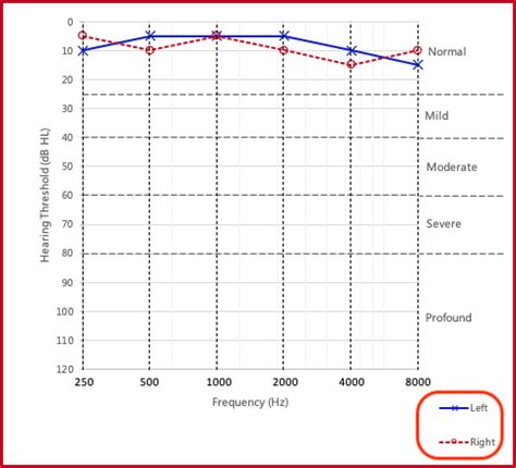 Detailed Explanation: How to Read an Audiogram – Incus Company Limited