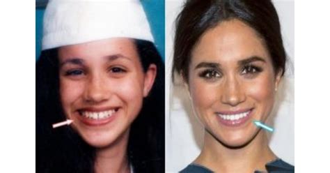 How Can I Get A Smile Like Meghan Markle's? - Bespoke Smile