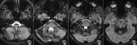 Radiology MRI: Superficial Siderosis