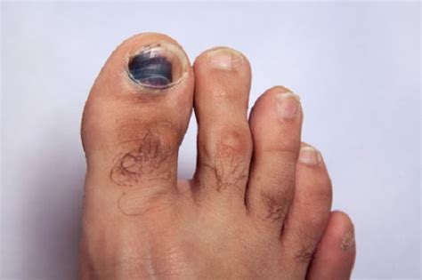 What causes black toenails? | FootWebStar