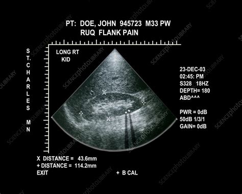 Ultrasound of kidney stones (renal calculi) - Stock Image - M165/0275 - Science Photo Library