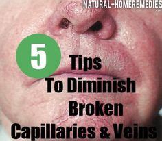 How To Diminish Broken Capillaries and Veins Spider Vein Treatment ...