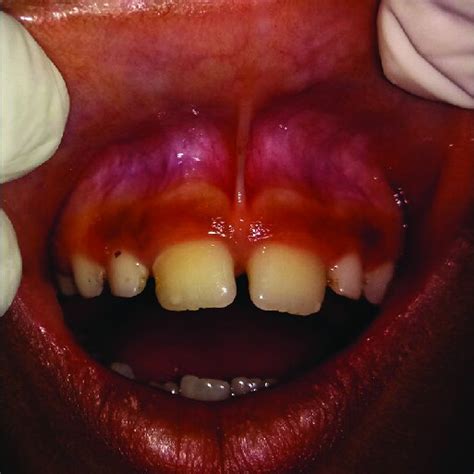 Preoperative view showing aberrant labial frenulum with midline ...