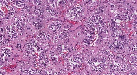 Paraganglioma | Atlas of Pathology