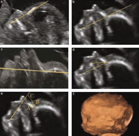 Trisomy 18 Ultrasound 13 Weeks