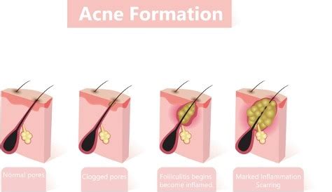 Acne and rosacesa Flashcards | Quizlet