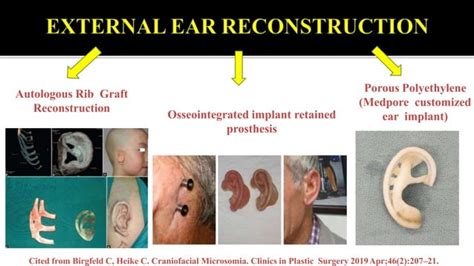 Facial asymmetry condylar hyperplasia and hemifacial microsomia