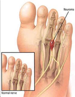 Morton's Neuroma Pain Treatment Sydney | Morton's Neuroma Surgery Sydney