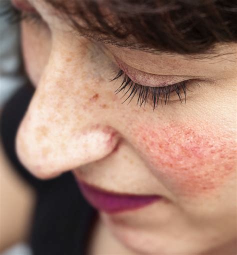 Blotchy Skin or Rosacea – What’s the Difference? | 100% PURE