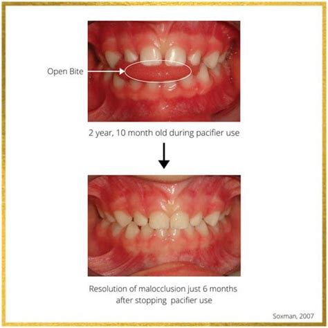 How To Correct Pacifier Teeth : Types Of Underbites Causes Treatment ...