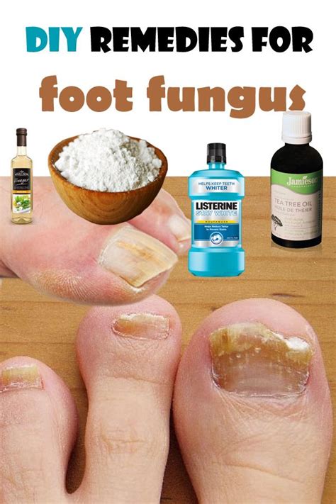 The 25+ best Toe fungus cure ideas on Pinterest | Toenail fungus medication, Toenail fungus cure ...