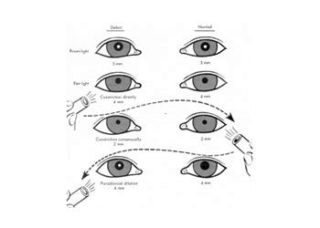 Normal Pupil Size for Perrla | Perrla Eyes