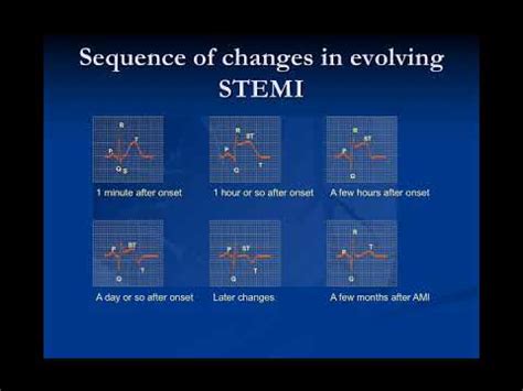 The ECG in acute coronary syndromes - YouTube