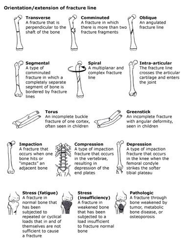 Fractures Flashcards | Quizlet