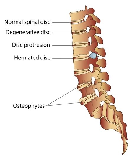 Leading an Active Lifestyle with Degenerative Disc Disease