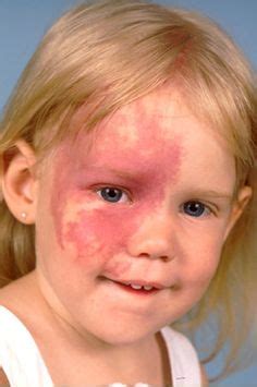 1000+ images about Birthmarks/ Port Wine Stains/ Sturge Weber Syndrome on Pinterest | Port Wine ...