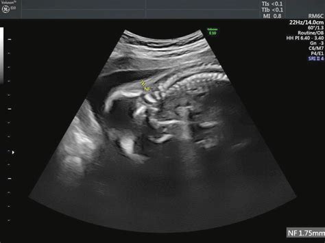 -Nuchal fold 1.75 mm (20 weeks of gestation, ultrasound examination). | Download Scientific Diagram