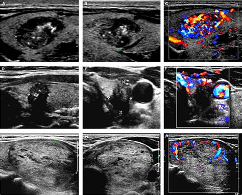 The application value of modified thyroid imaging report and data system in diagnosing medullary ...