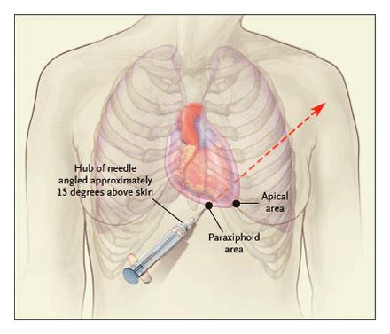 Pericardial and Myocardial Disease - Crashing Patient