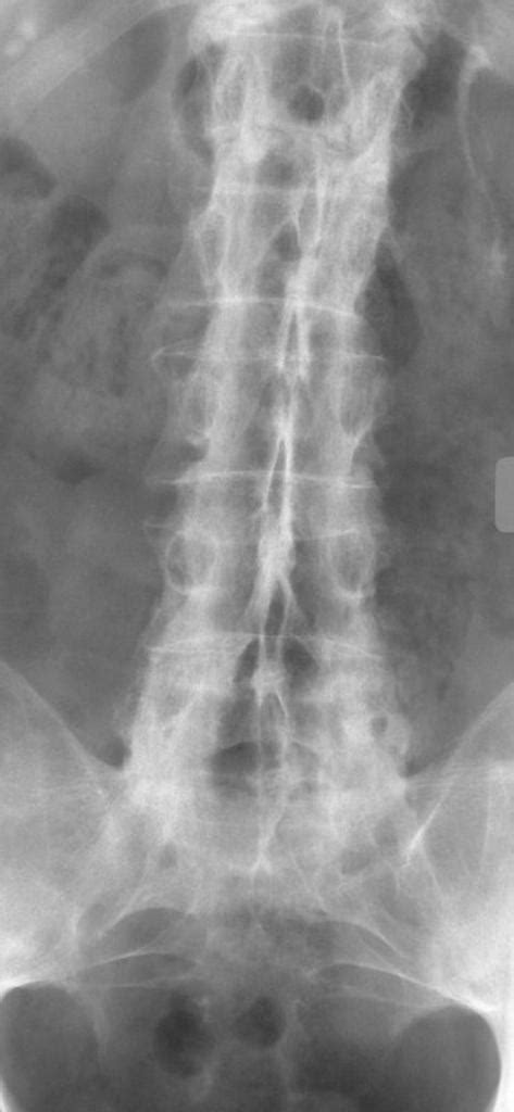 Ankylosing spondylitis x ray - wikidoc