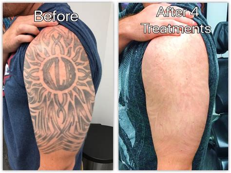 Laser Tattoo Removal Before and After update -2021 - Tattoo Shoo | Tattoo removal, Laser tattoo ...