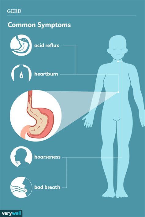 GERD: Signs, Symptoms, and Complications