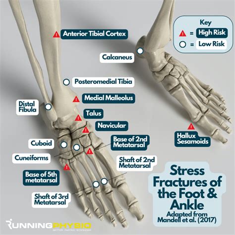 Stress fractures of the foot & ankle [infographic] - RunningPhysio