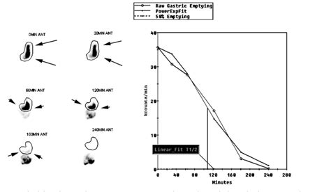 What is Gastric Emptying Study? Example – Health Maintain