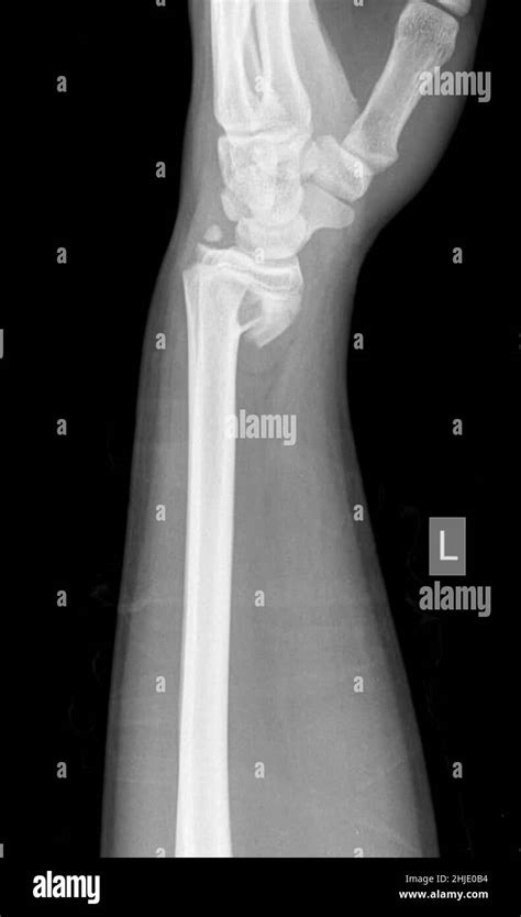 Smith fracture, X-ray Stock Photo - Alamy