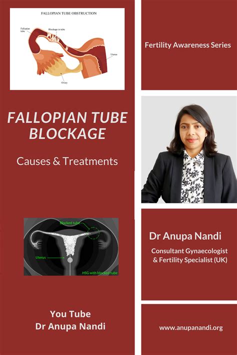 Fallopian tube blockage causes treatment – Artofit