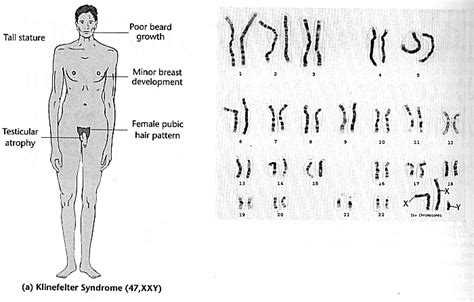 El Sindrome De Klinefelter - Taringa!