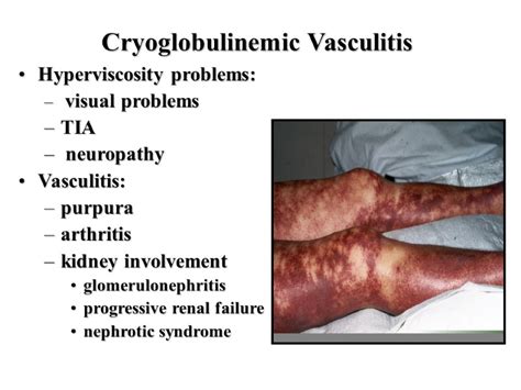 VASCULITIS Alexandra Balbir-Gurman Definition Blood vessels inflammation and