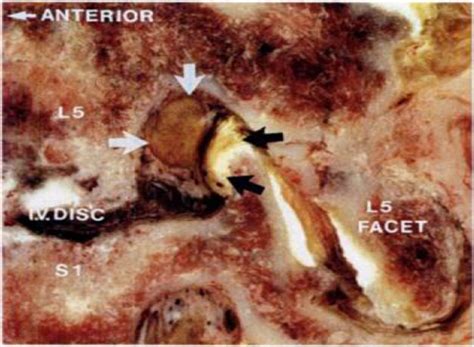 Endoscopic Foraminal Decompression for Failed Back Surgery Syndrome ...