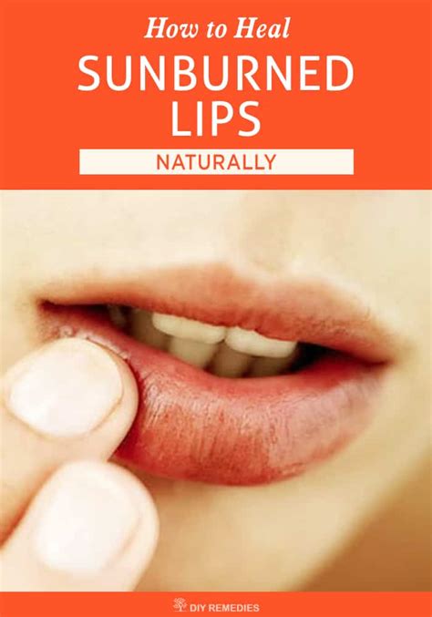 How to Heal Sunburned Lips Naturally