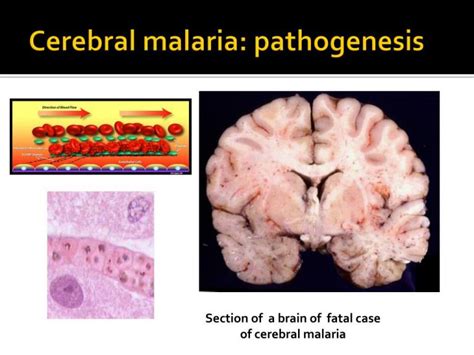 WHO Definition of Cerebral Malaria - Public Health