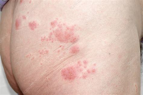 Shingles rash on the buttock - Stock Image - C021/3405 - Science Photo Library