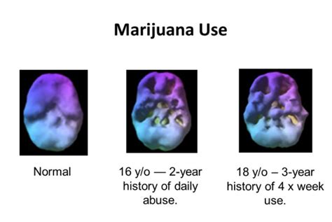 Marijuana Education Articles - Every Brain Matters