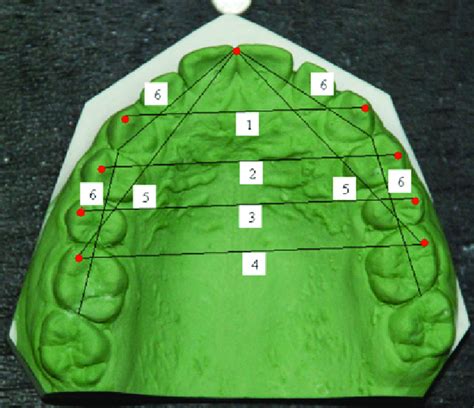 Dental arch dimensions on the dental cast including intercanine (1 ...