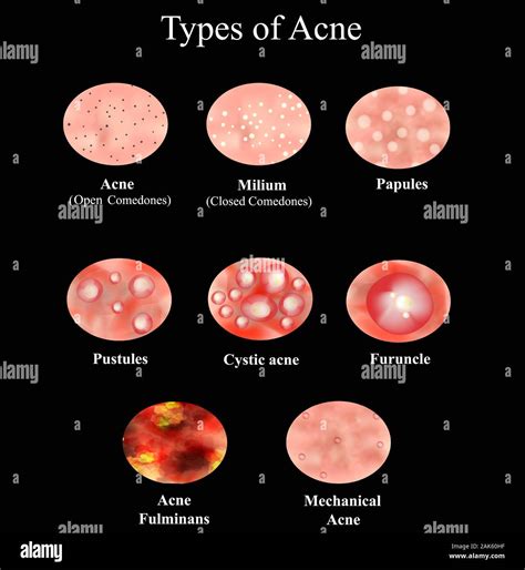 Types of Acne Skin inflammation. Pimples, boils, whitehead, closed comedones, papules, pustules ...