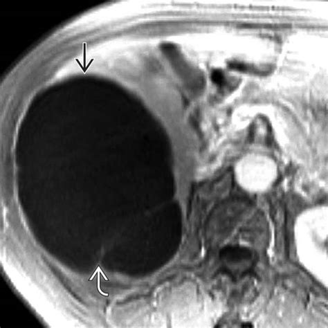 Hepatic Cyst | Radiology Key